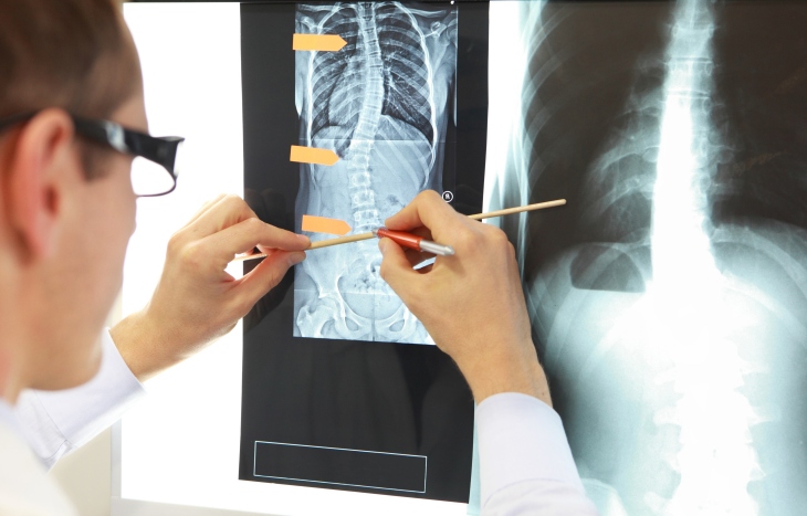 “Bir doktor, skolyoz teşhisi için hastaya ait omurga röntgen filmini detaylı şekilde inceliyor.”