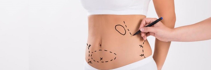 Ultrasonik Liposuction Yardımlı Bel ve Karın Şekillendirme